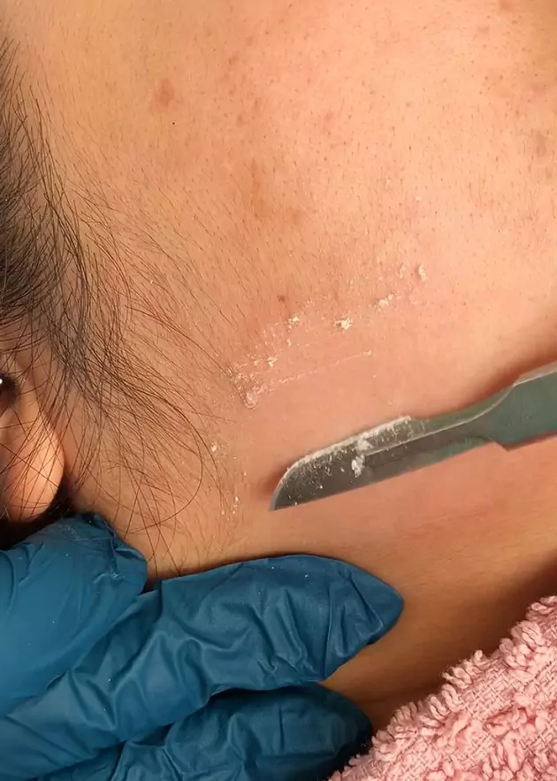 تعبیر خواب موی زائد بدن و صورت + موهای زائد زیر بغل و عورت زنان و دختران